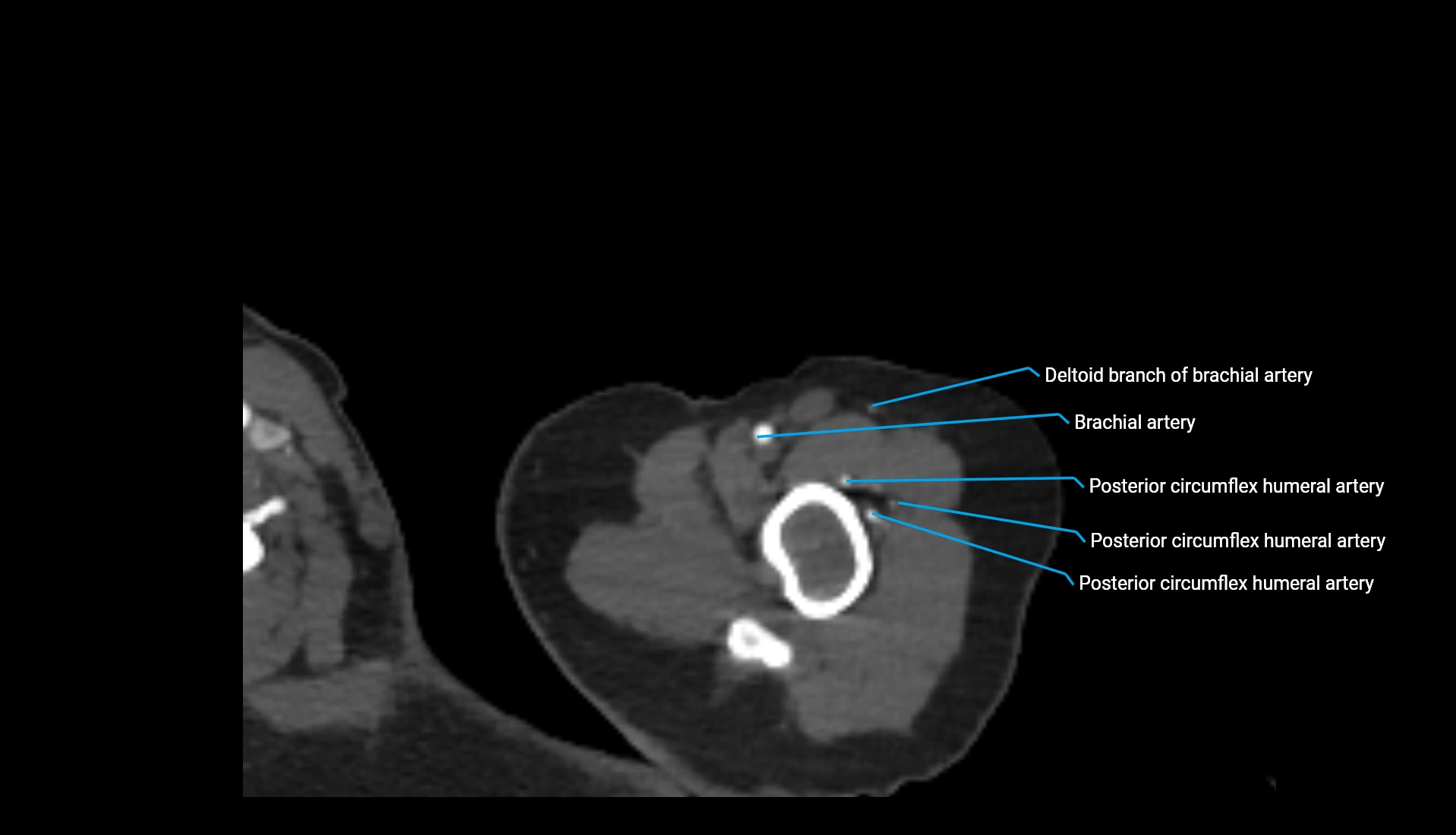CTA upper limb axial cross sectional anatomy labelled image 311 (1).webp